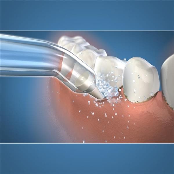 Waterpik SubGingival spets 2st