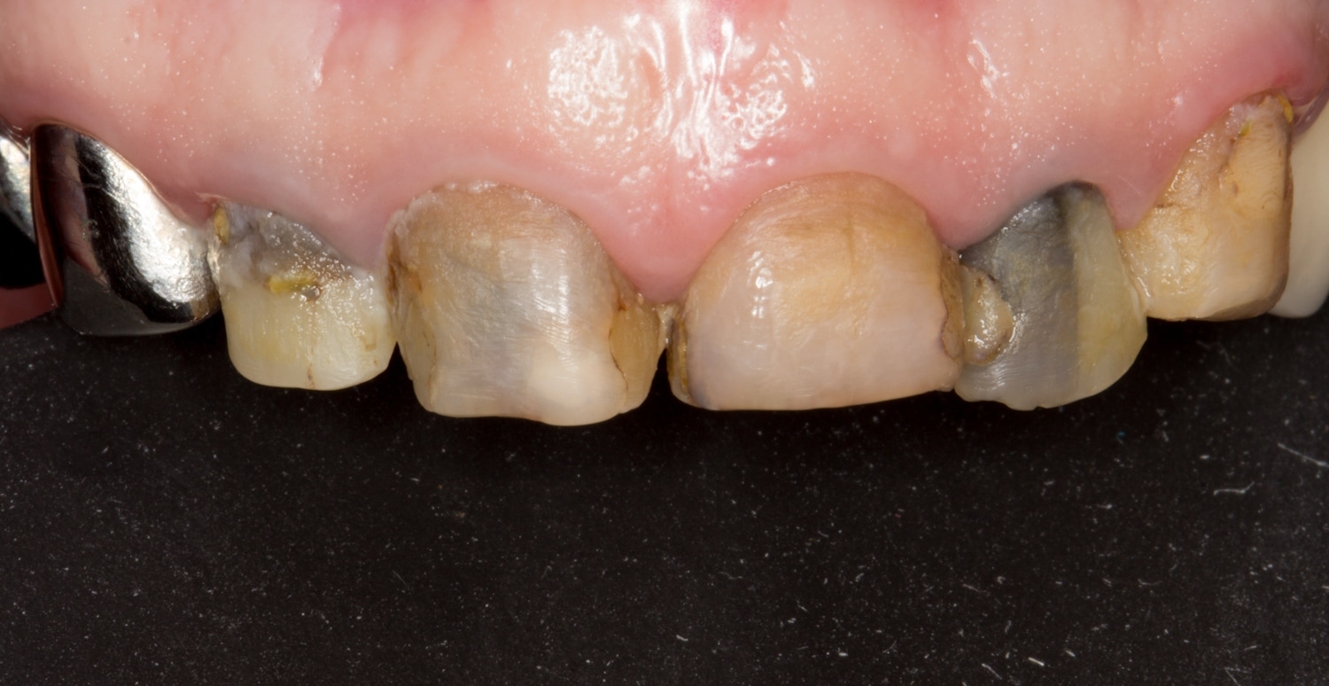 Contrastor Silicon Double L+S Palatal